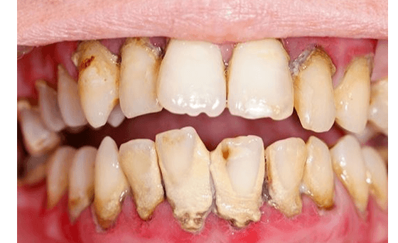 Nghiên cứu tham khảo về tia hồng ngoại xa trong nha khoa