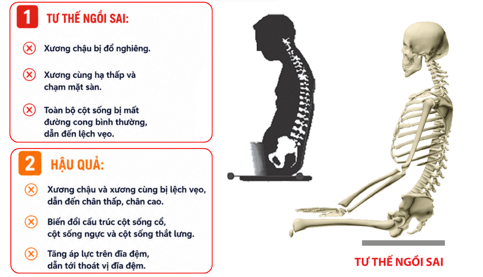 Ngồi thiền sai làm lệch xương chậu, xương cùng, xương cụt